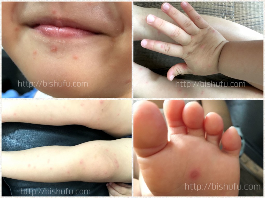 手足口病（子供の症状画像）